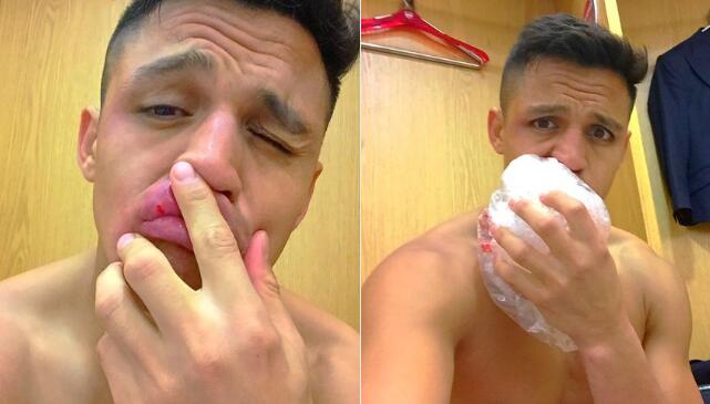 阿森纳1-0莱斯特城 桑切斯嘴唇被球砸肿 温格出面维护